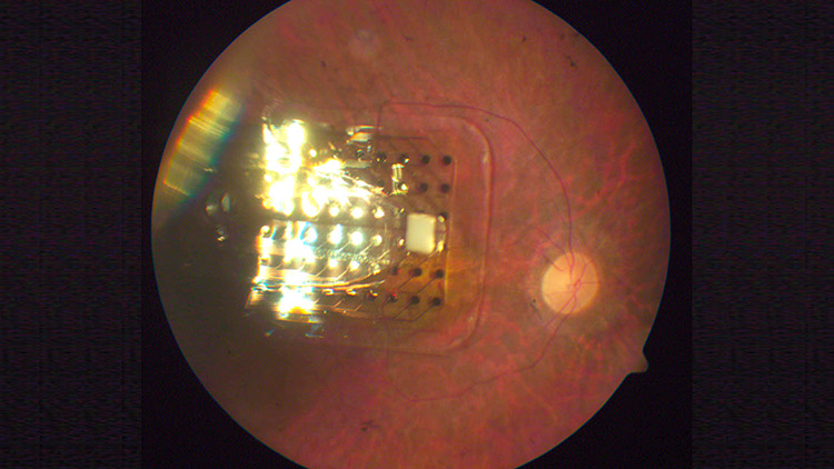 Artificial Retina