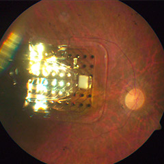 Artificial Retina